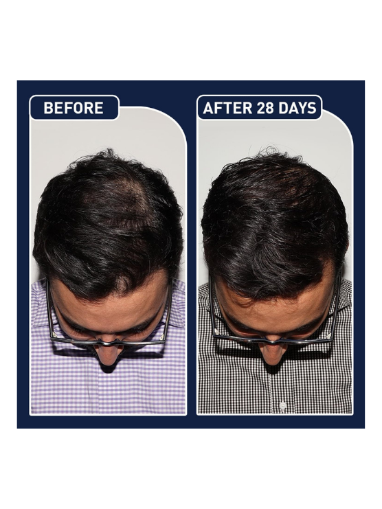 FEGPlus Minoxidil Beard & Hair Growth Serum